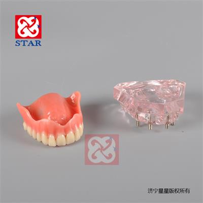 4個微型種植釘，上頜一尺修復。M6001